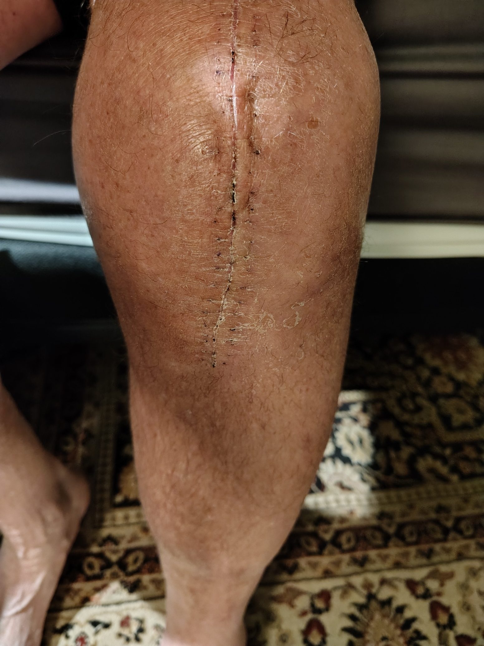 Knee scar